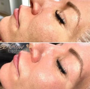 BB Glow Behandlung: schöne Haut ohne Make-up auftragen!